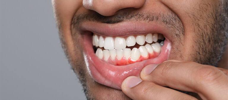 Bleeding Gums: The Early Warning Sign of Gum Disease You Shouldn’t Ignore