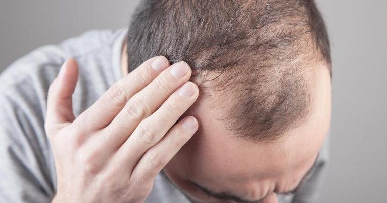 Does Stress Really Cause Hair Fall? What Happens to Your Hair When You Are Anxious